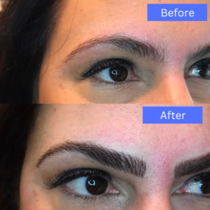 microneedling before and after picture 3