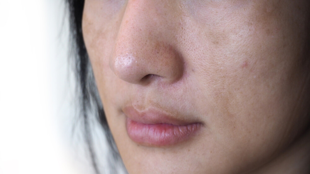 melasma after microneedling