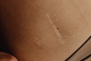 scar microneedle treatment